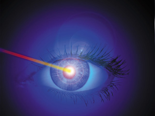 Laser eye surgery